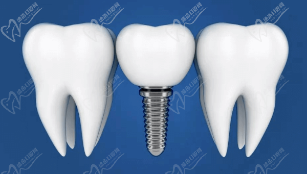 Dental implants vs ceramic crowns