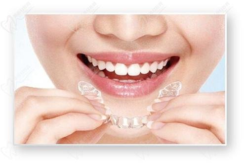 Class II malocclusion treatment