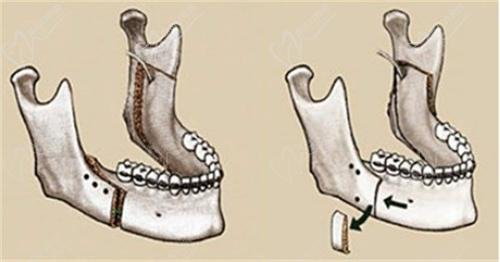 Class II malocclusion treatment