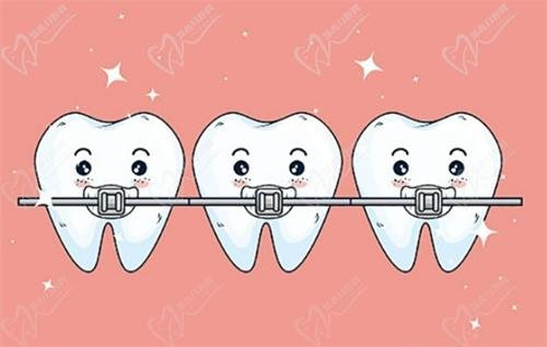 Class II malocclusion treatment