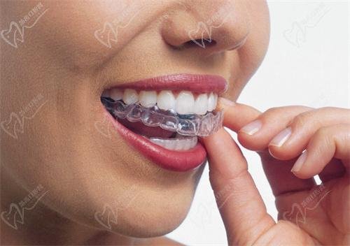 Class II malocclusion treatment