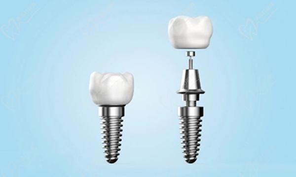 Korean vs German dental implants