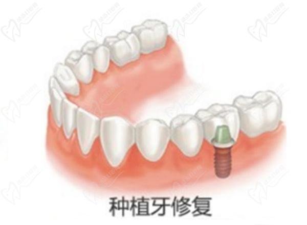 Korean vs German dental implants