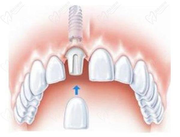 Korean vs German dental implants
