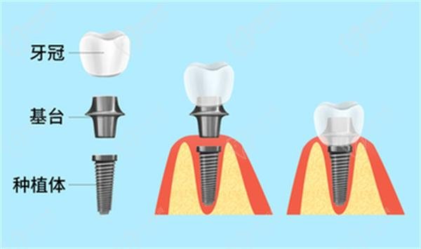 Korean vs German dental implants
