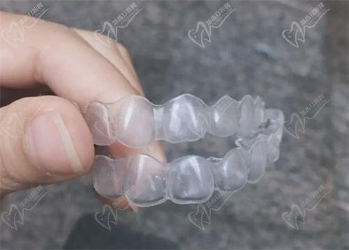 Class I malocclusion treatment