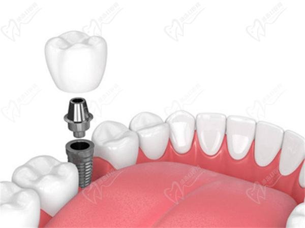 Dental implants and coronary heart disease