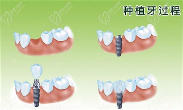 Dental implants and coronary heart disease