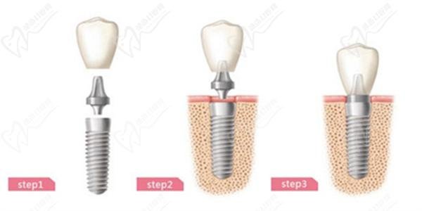 Dental implants and coronary heart disease