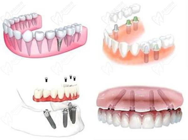Dental implants and coronary heart disease